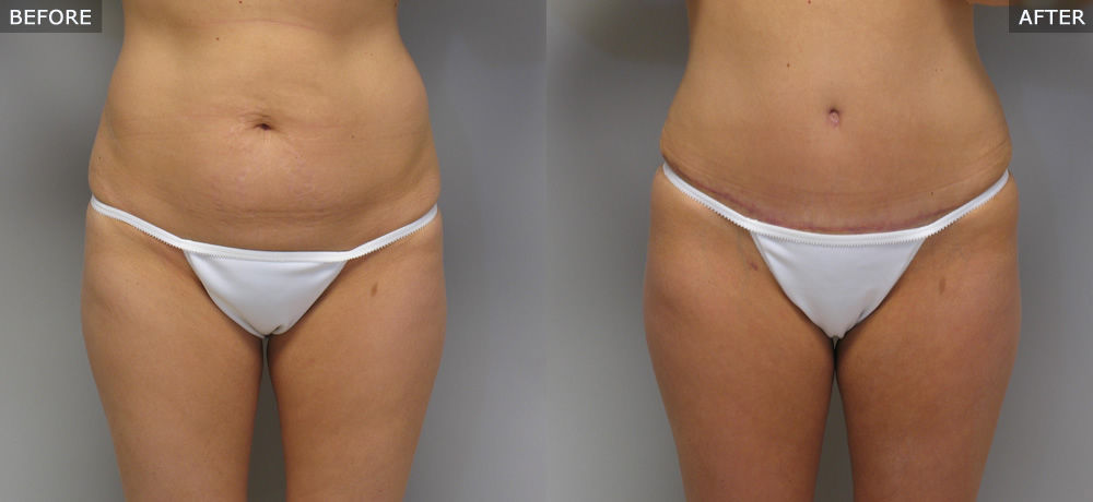 Abdominoplasty (Tummy Tuck) Before & After Photos example one front