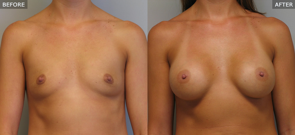 breast augmentation springfield mo before and after photos example two