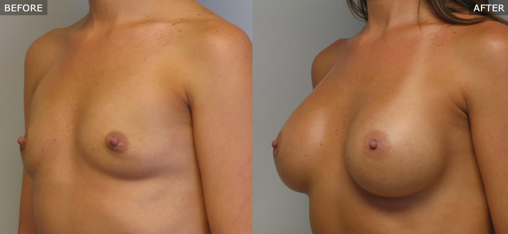 breast augmentation springfield mo before and after photos example two