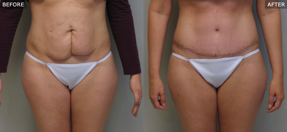 Abdominoplasty (Tummy Tuck) Before & After Photos example two front