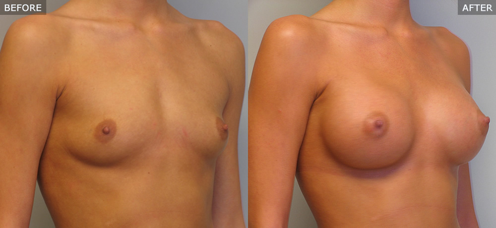 breast augmentation springfield mo before and after photos example one