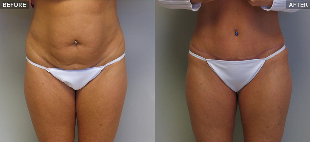 Abdominoplasty (Tummy Tuck) Before & After Photos example three front