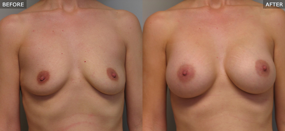 breast augmentation springfield mo before and after photos example one