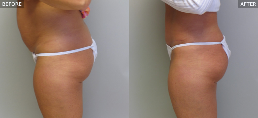 Abdominoplasty (Tummy Tuck) Before & After Photos example three side