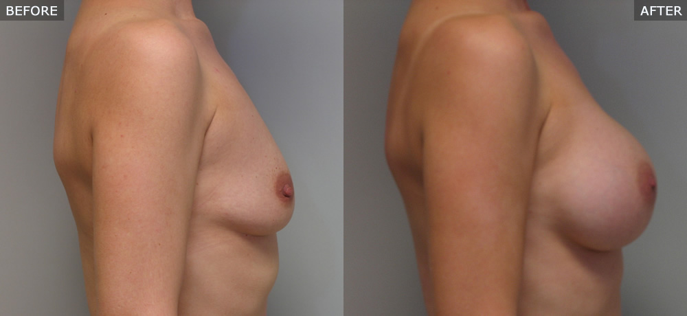 breast augmentation springfield mo before and after photos example three