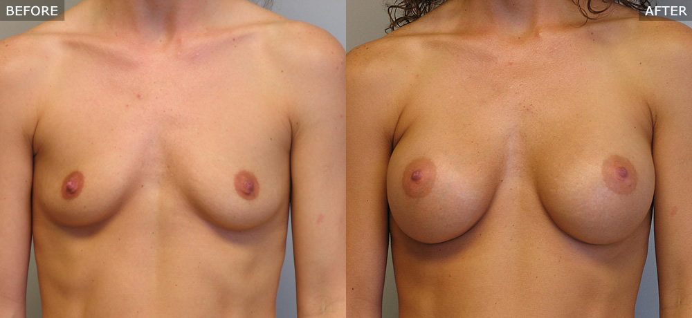 breast augmentation springfield mo before and after photos example four