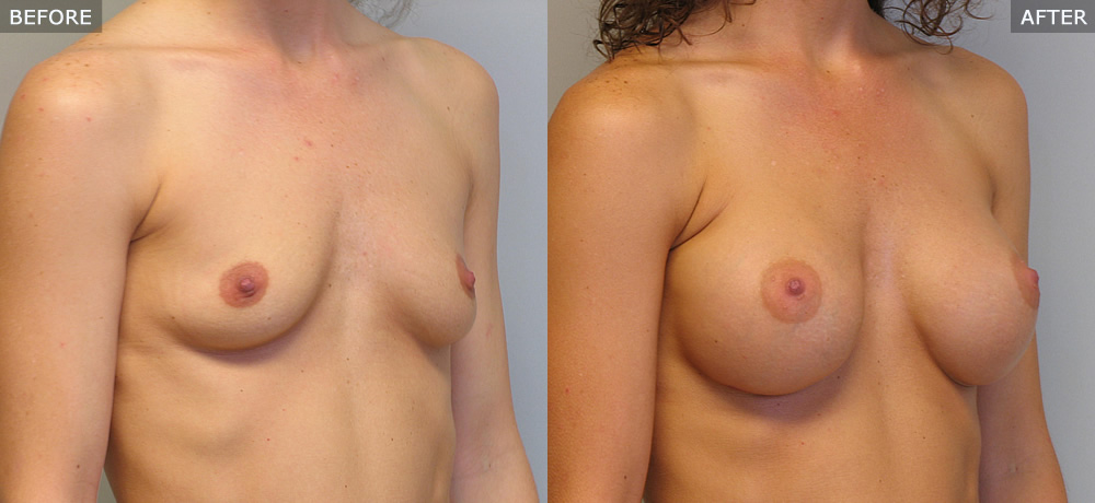 breast augmentation springfield mo before and after photos example four