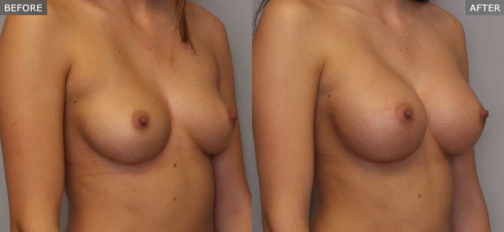 Photo of Breast Augmentation Before and After Side View Example 5