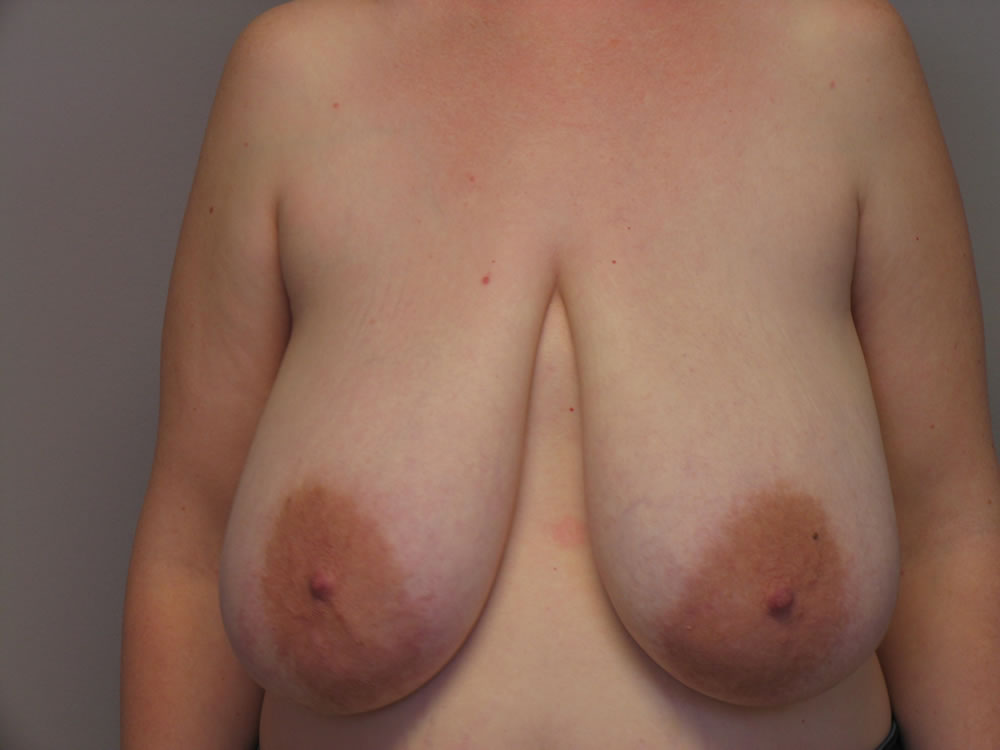 breast-reduction-free-nipple-graft-spingfield-mo-example-1-front-before