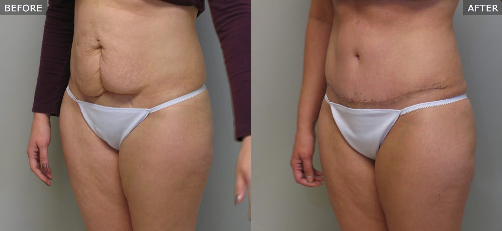 Abdominoplasty (Tummy Tuck) Before & After Photos example two side