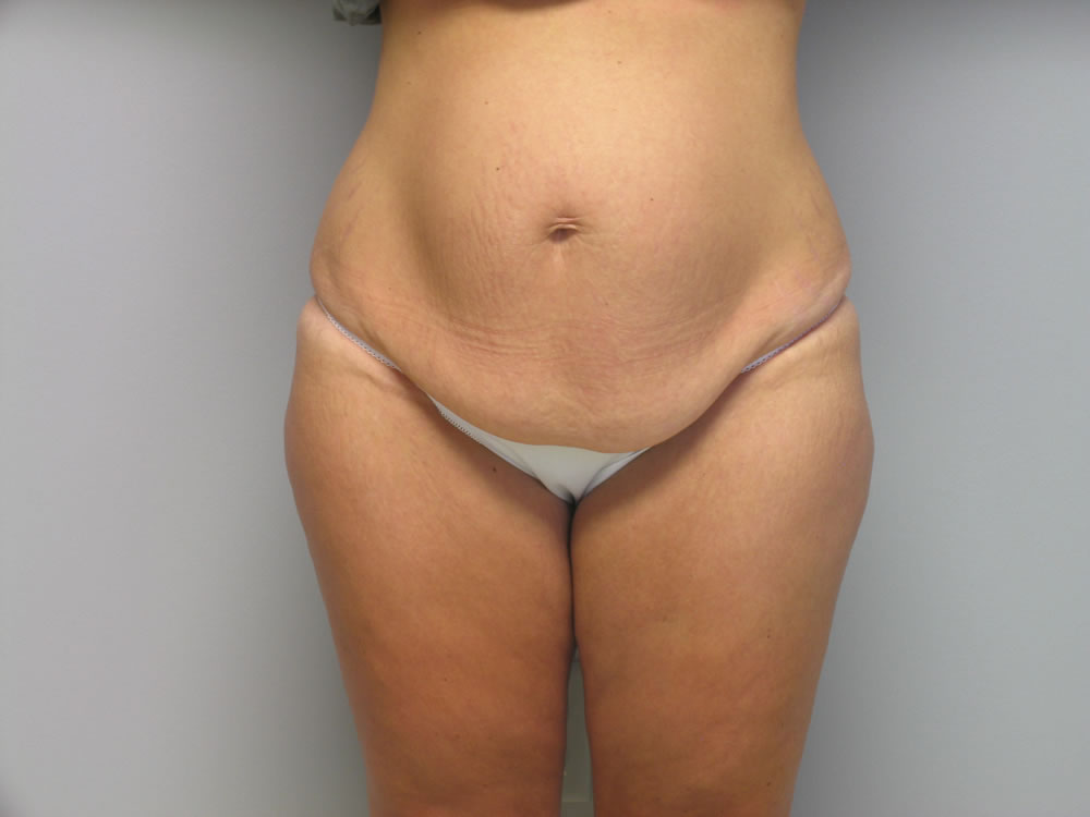 body-lift-springfield-mo-example-1-front-before