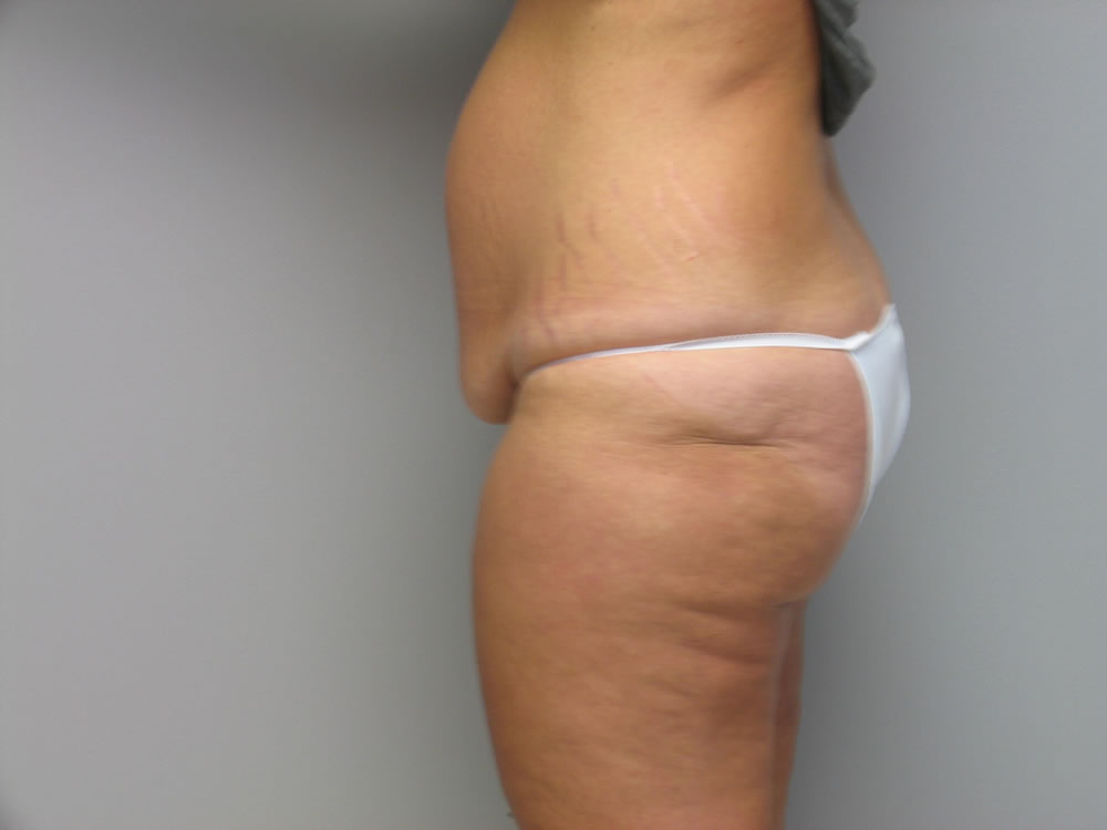 body-lift-springfield-mo-example-1-side-before