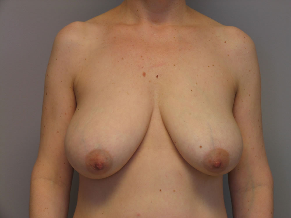 breast-lift-springfield-mo-example-1-front-before