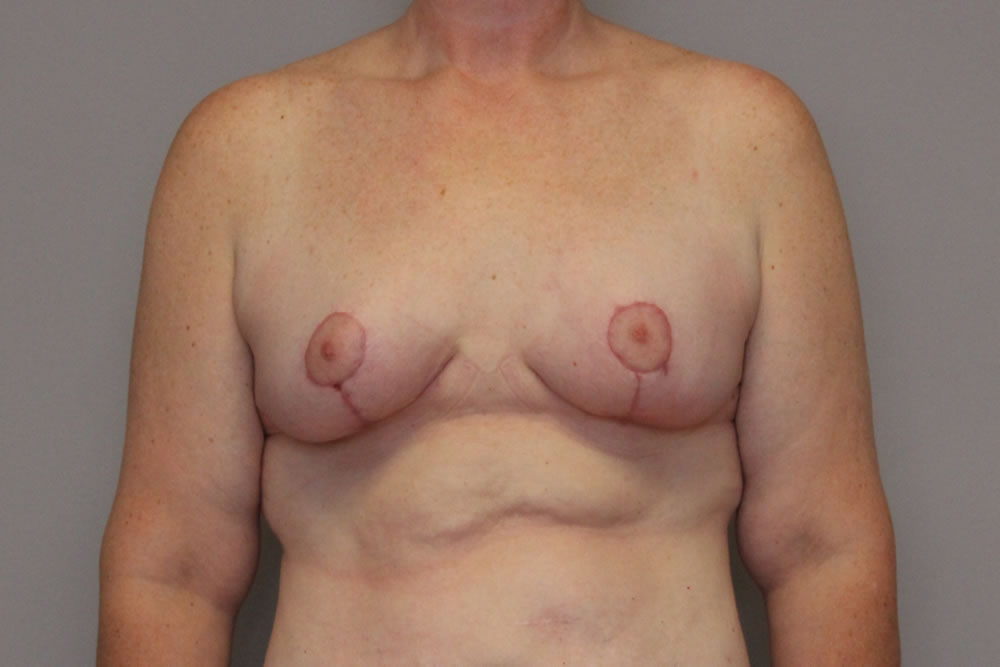 breast-lift-springfield-mo-example-3-front-after