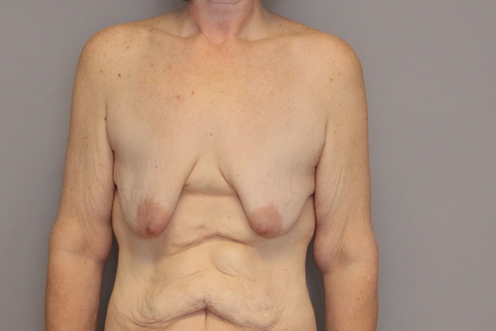 breast-lift-springfield-mo-example-3-front-before