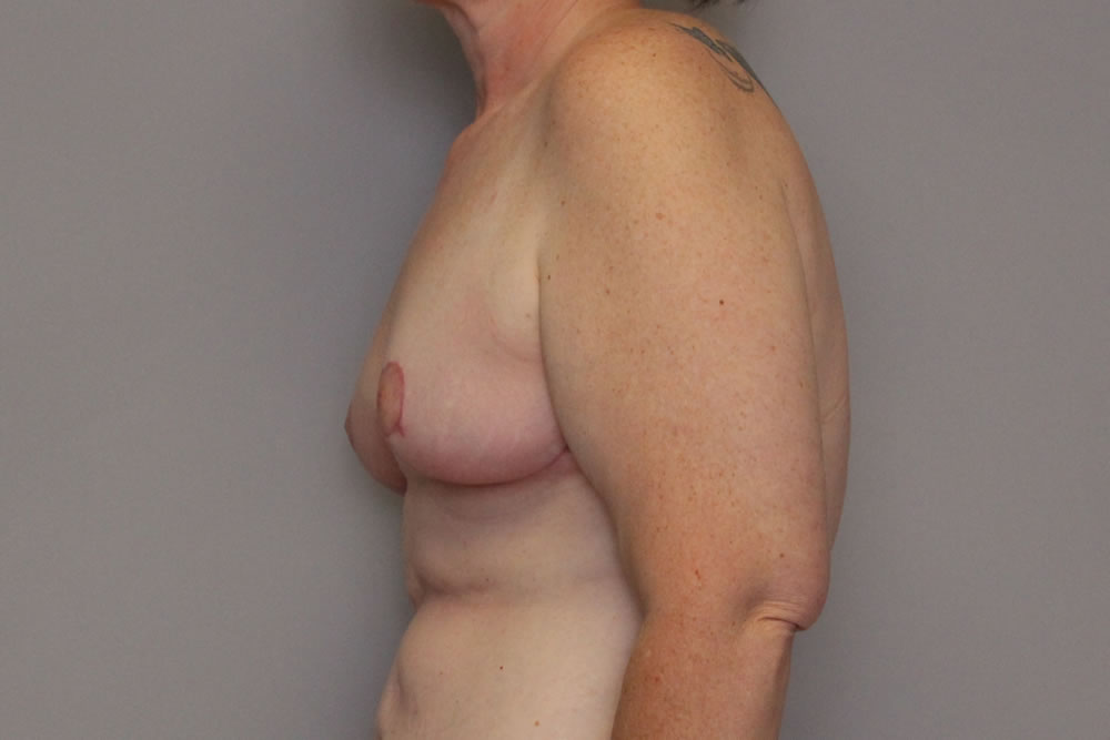 breast-lift-springfield-mo-example-3-side-after