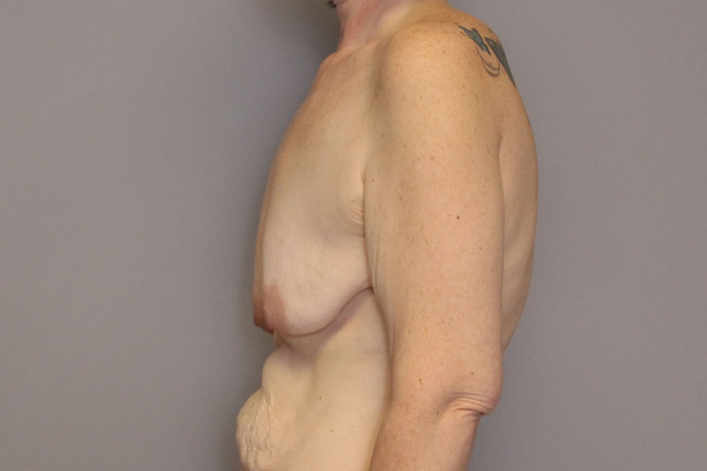 breast-lift-springfield-mo-example-3-side-before