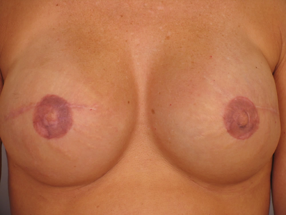 breast-reconstruction-springfield-mo-example-1-front-after
