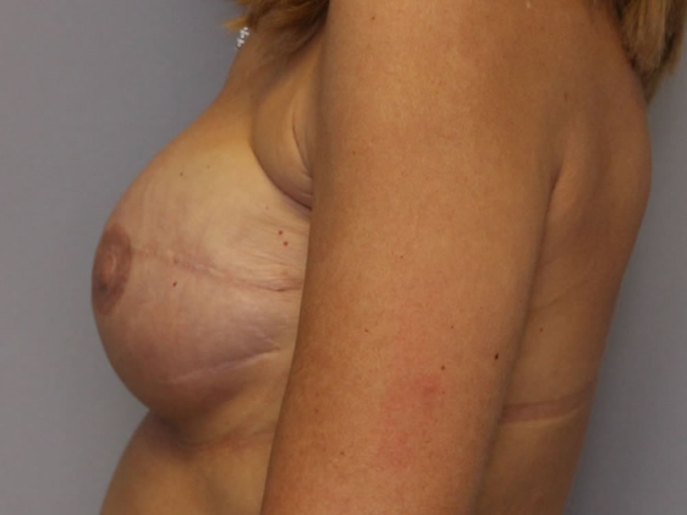 breast-reconstruction-springfield-mo-example-1-side-after-v2-crop
