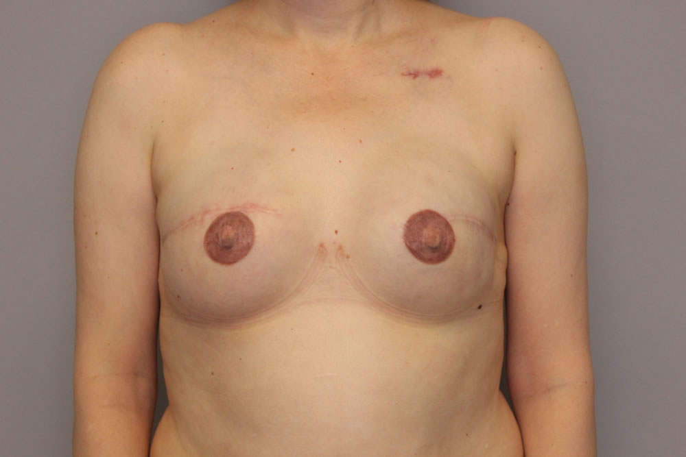 breast-reconstruction-springfield-mo-example-2-front-after