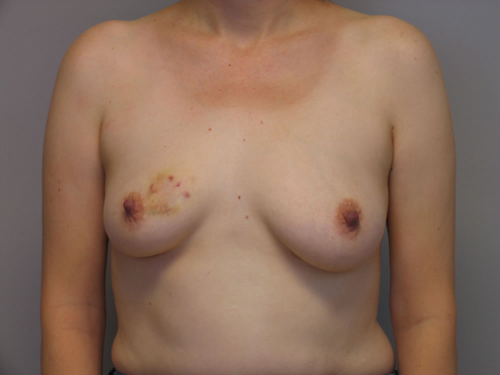 breast-reconstruction-springfield-mo-example-2-front-before