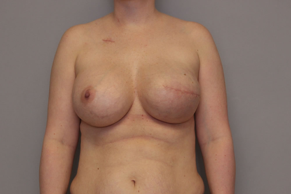 breast-reconstruction-springfield-mo-example-3-front-after