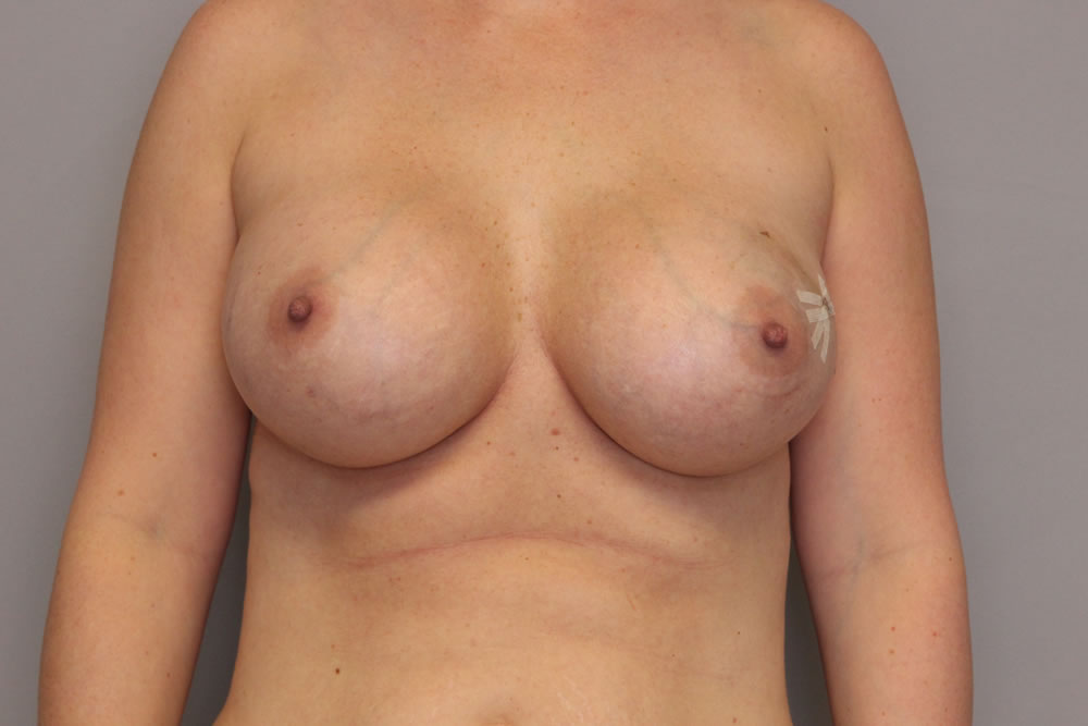 breast-reconstruction-springfield-mo-example-3-front-before
