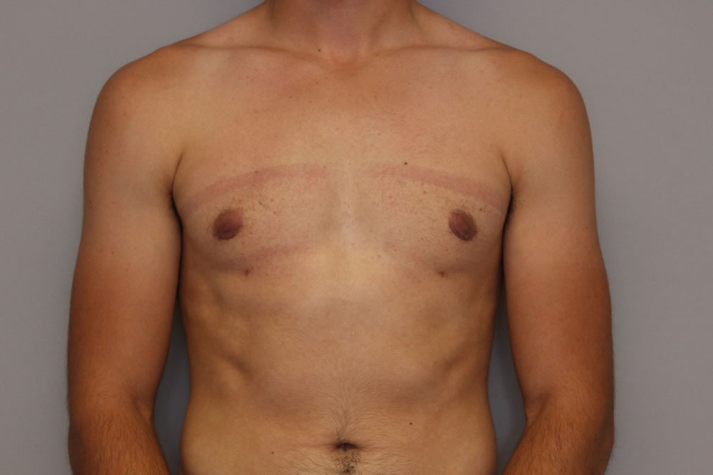 gynecomastia-springfield-mo-example-1-front-after