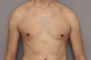 gynecomastia-springfield-mo-example-2-front-after