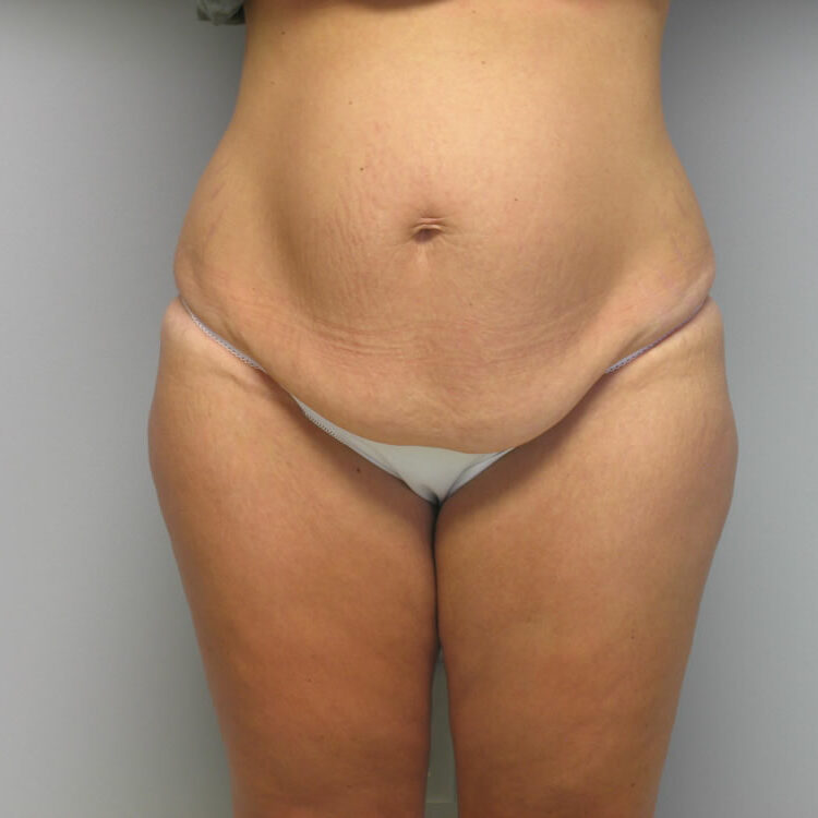 body-lift-springfield-mo-example-1-front-before
