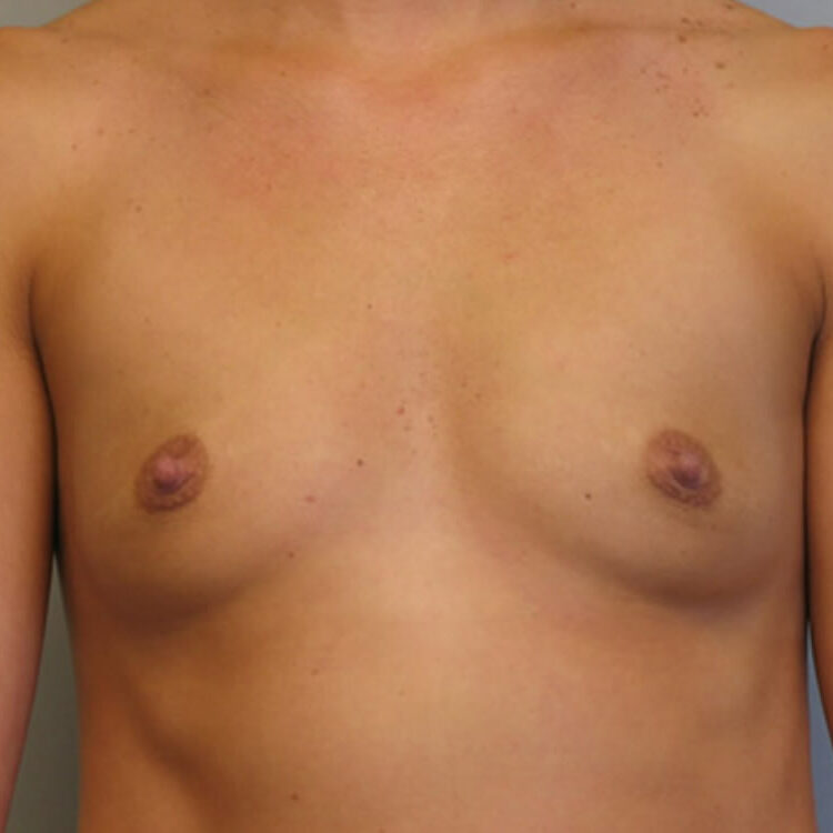 breast-augmentation-springfield-mo-before-and-after-photos