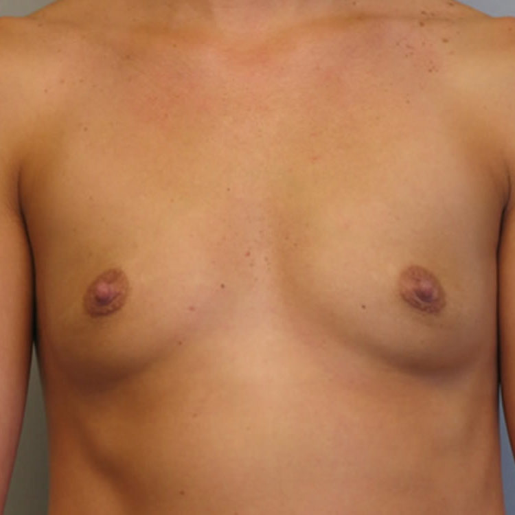 breast-augmentation-springfield-mo-before-and-after-photos