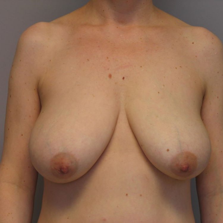 breast-lift-springfield-mo-example-1-front-before