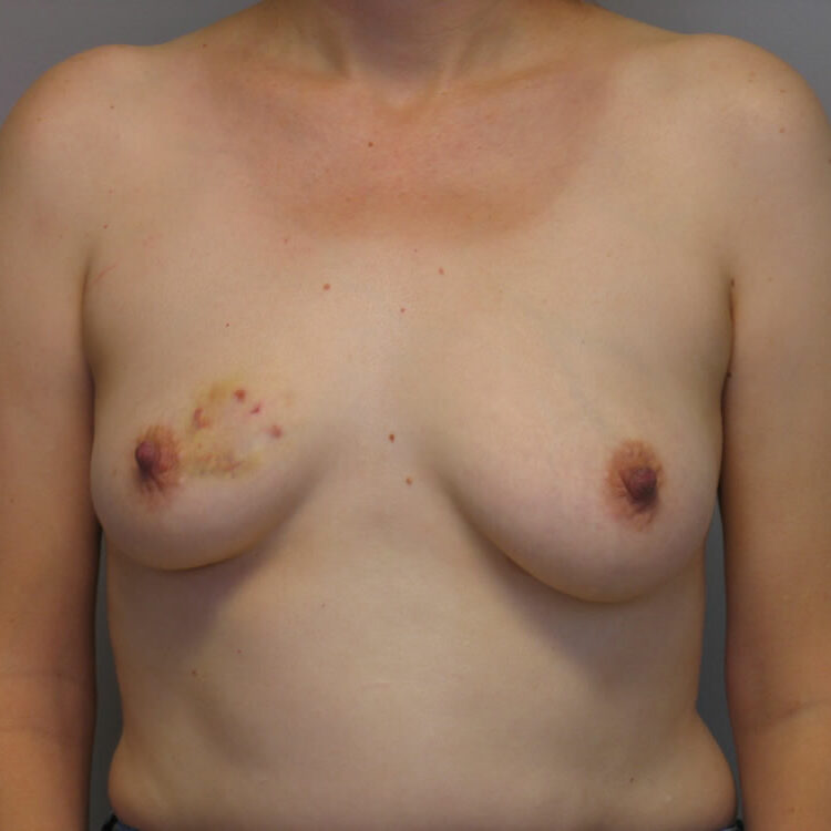 breast-reconstruction-springfield-mo-example-2-front-before