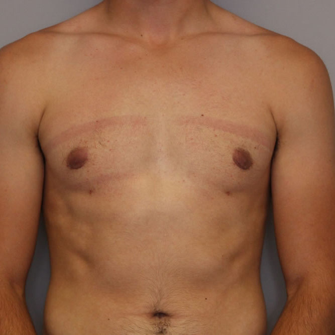 gynecomastia-springfield-mo-example-1-front-after