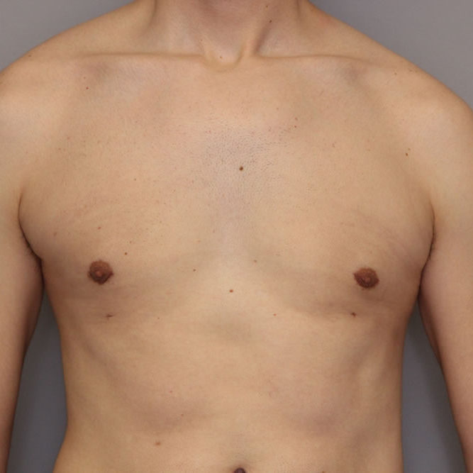 gynecomastia-springfield-mo-example-2-front-after