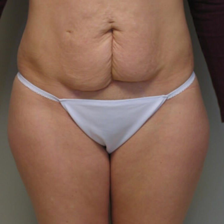 tummy-tuck-springfield-mo-before-and-after-photos